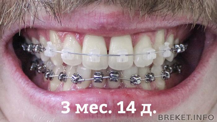 ВЧ 3 месяца 14 дней