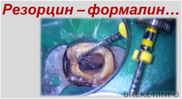 Гематома на корне зуба Гематома на корне зуба