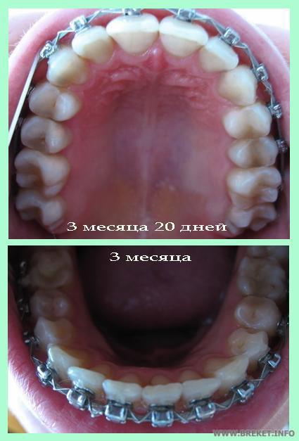 2ая замена дуги