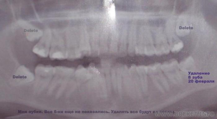 Рентген моих зубиков