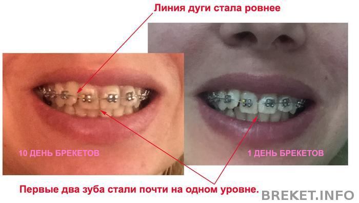 Первые 10 дней ношения брекетов, есть первые результаты