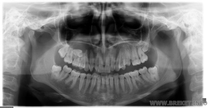 моя ортопантомограмма
