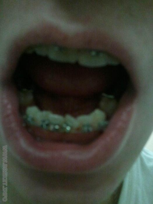 Resize_of_niz.jpg Низ. 10 месяцев. 2 дня после удаления слева, неделя справа.