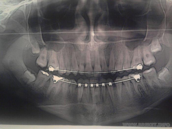 ортопантомограмма 4 мес 22 дня