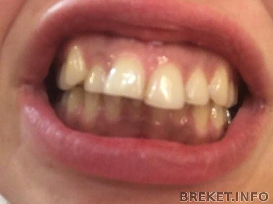 Фотка моих страшных зубьев