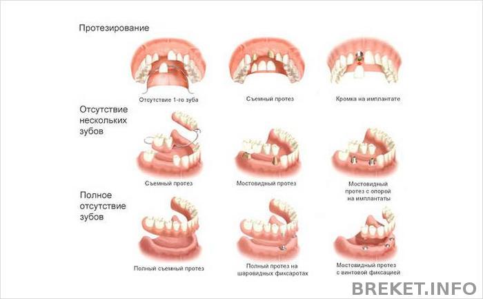vidy_protezov.jpg