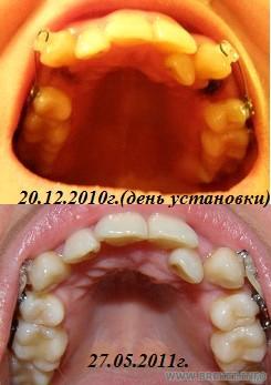 1 день и  5 мес. 7 дней ВЧ