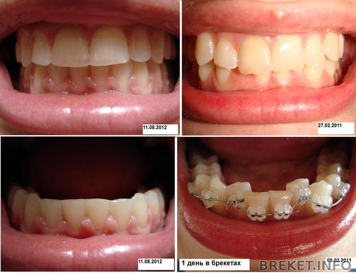 до и после брекетов