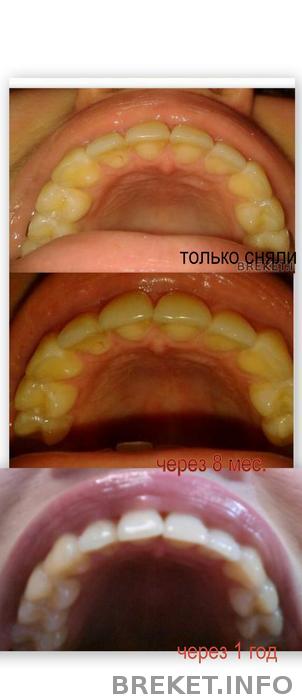 если кому интересно, год после снятия, правый зуб так и лезет обратно)