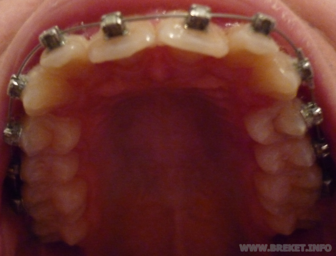 ВЧ, 2 недели.