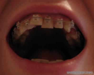 Верхние зубы. Начало, декабрь 2010