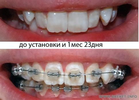 смыкание 1 мес 23 дня.jpg
