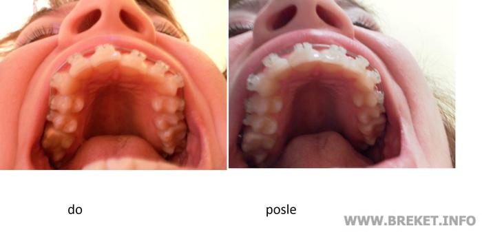 Керамические брекеты до и месяц спустя