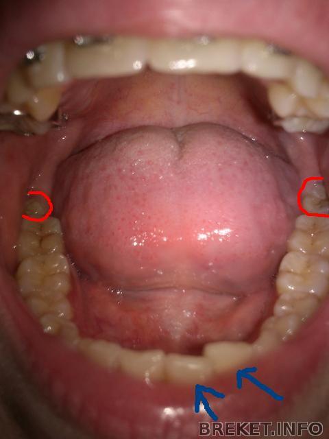Зубы мудрости вытеснули единичку
