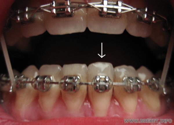 Зуб после переклеивания брекета.