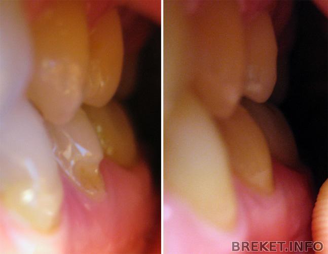 клиновидный дефект до и после (плюс заметно движение зубов после снятия)