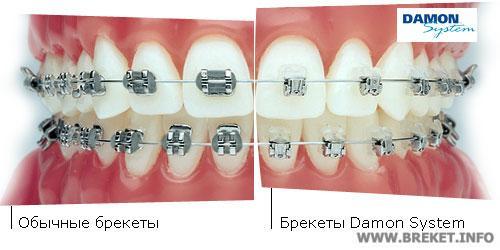 Damon 3, сравнение с лигатурными