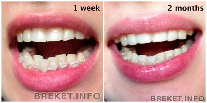 teeth-2months.jpg