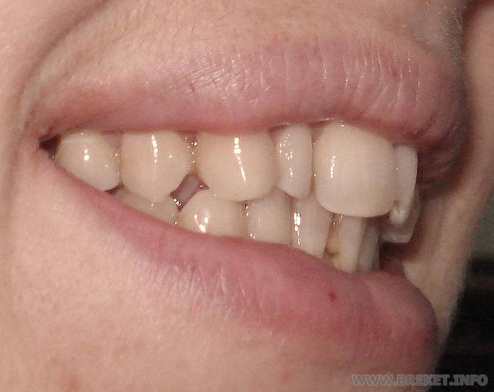 зубы (вид справа)