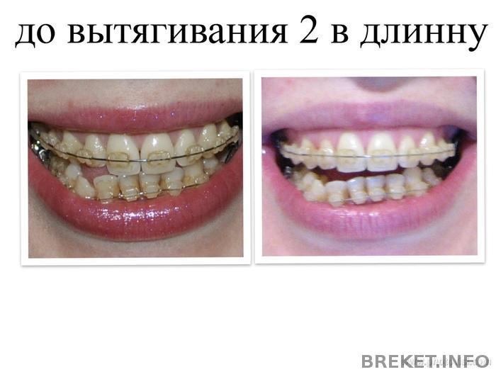 do_vytyagivaniya_2_v_dlinnu.jpg