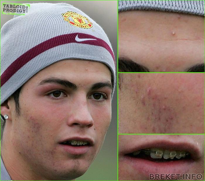 ronaldo-acne.jpg