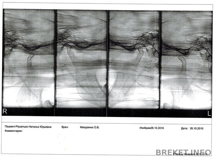Компьютерная томограмма челюстных суставов.jpg
