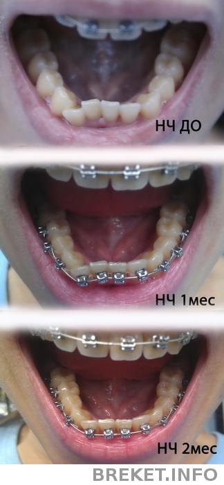 НЧ 0 - 1 - 2 месяца