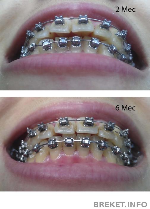 Прикус 2 - 6 месяцев