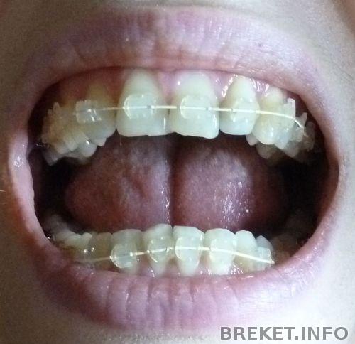 lowerbraces.jpg