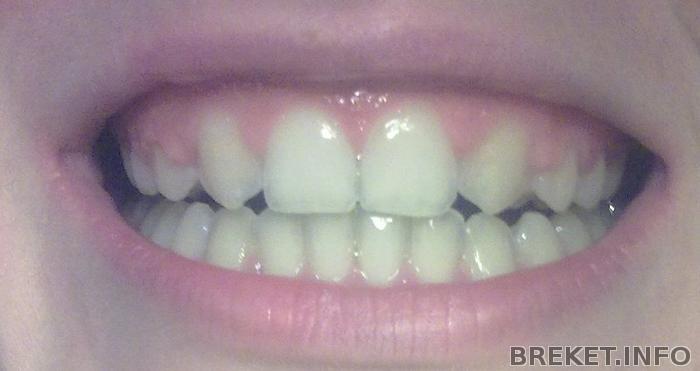 Зубы после ношения БС (срок 3 года с хвостиком)