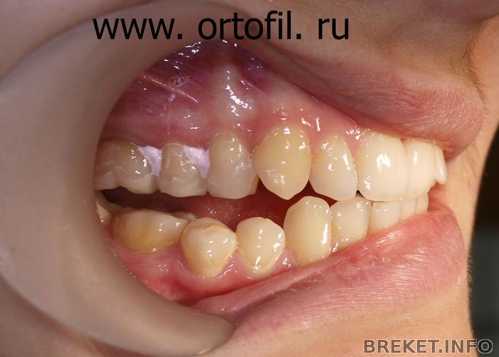 6._mok-ap_na_verh._bokovye_zuby_po_hip_02.jpg