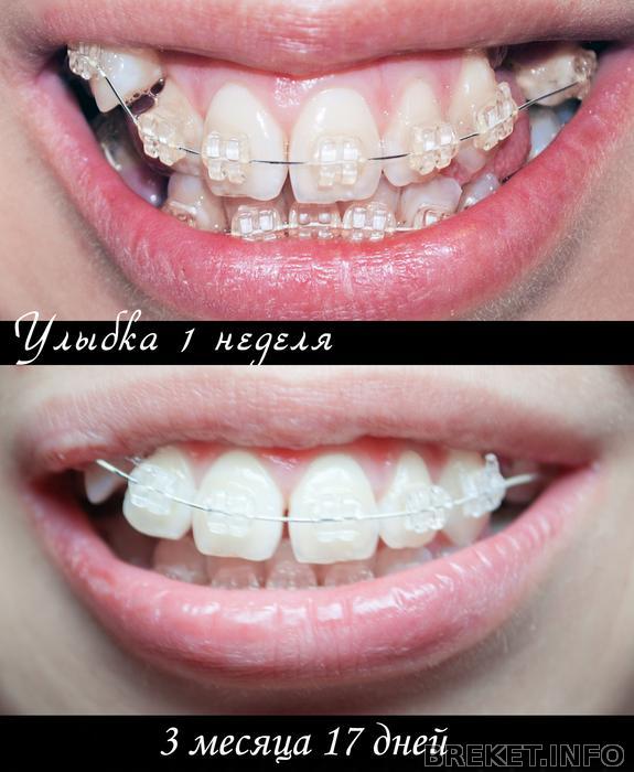 sravnenie_ulybki_ot_nachala_do_317.jpg