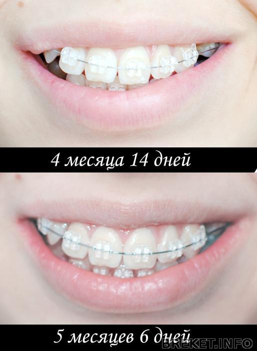 5_sranenie_ulybka.jpg