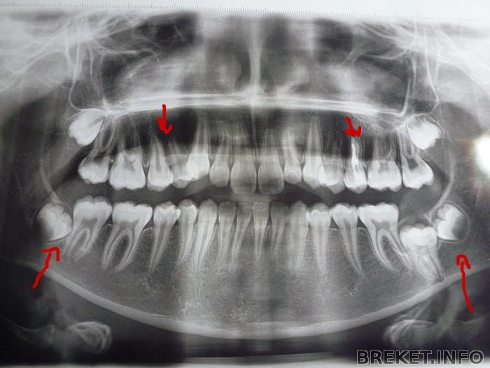 те зубы которые надо удалить помечены красной стрелкой