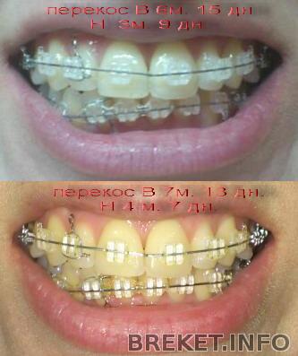 perekos_v_7m13d_n_4m7d.jpg