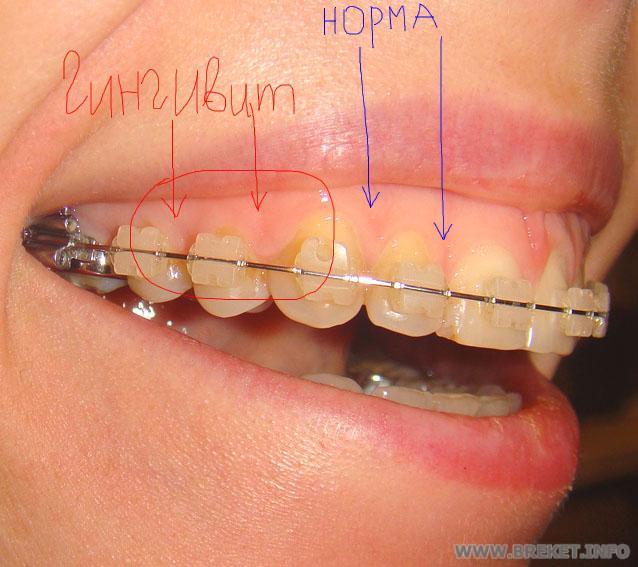 Гингивит ВЧ.jpg