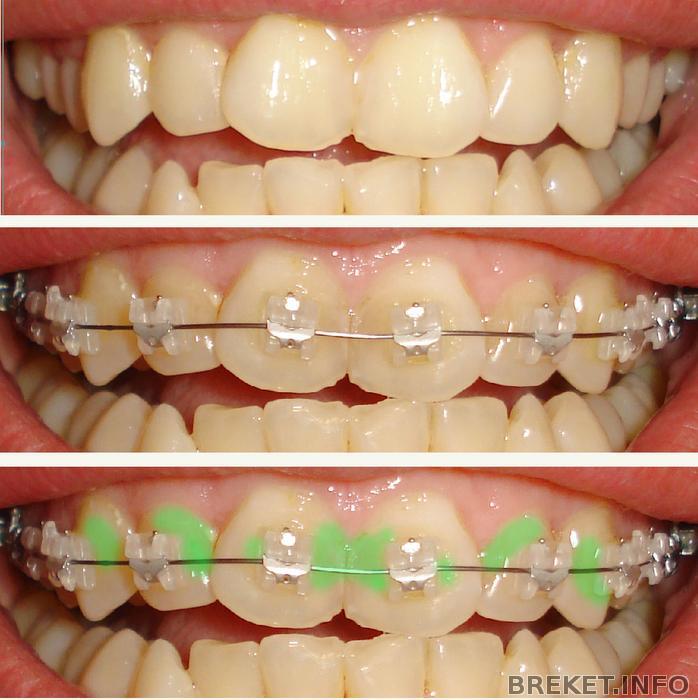 Появились пятна после установки брекетов