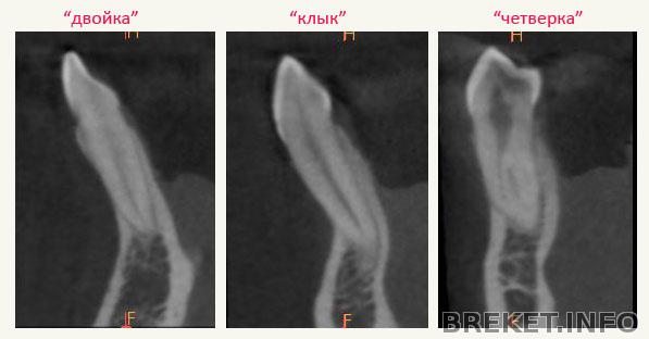 КТ - в разрезе, передние зубы