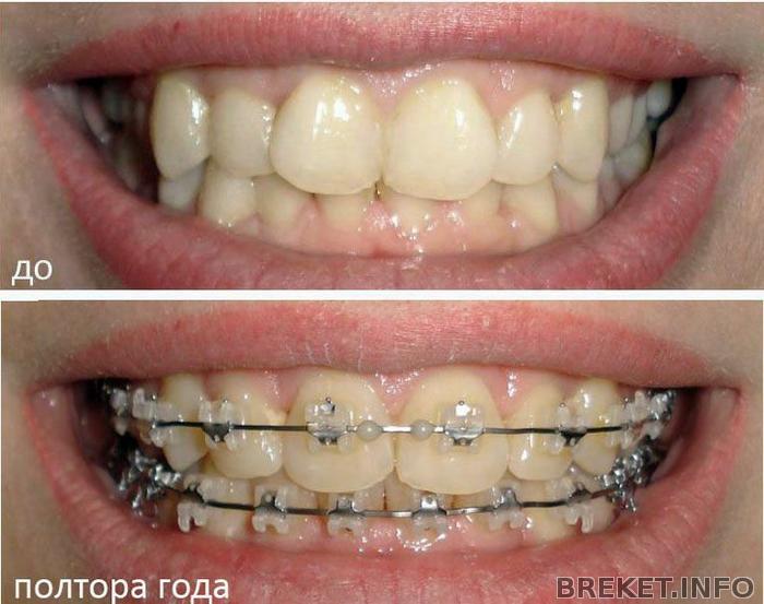 Полтора года- смыкание фронт