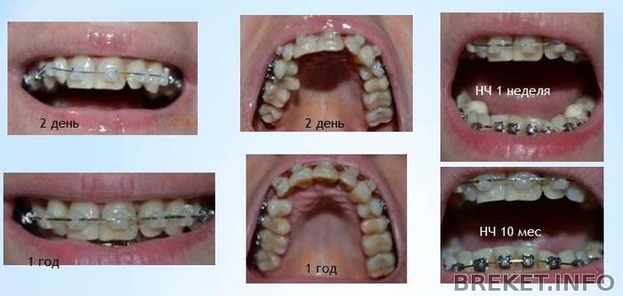 1 год брекетам