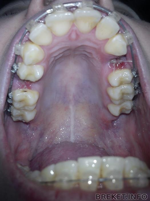 После удаления зубов