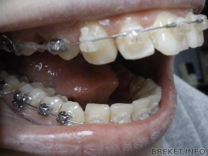 Чейн - эластичная цепочка после удаления зуба