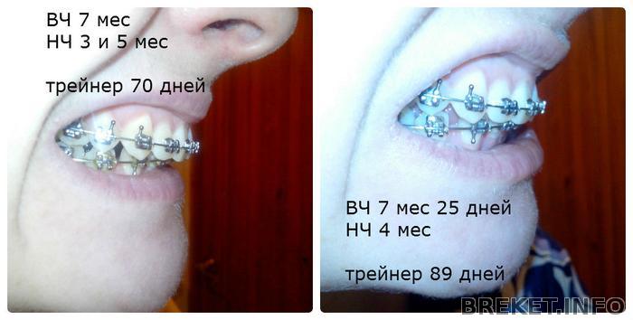 7 мес ВЧ и 4 мес НЧ