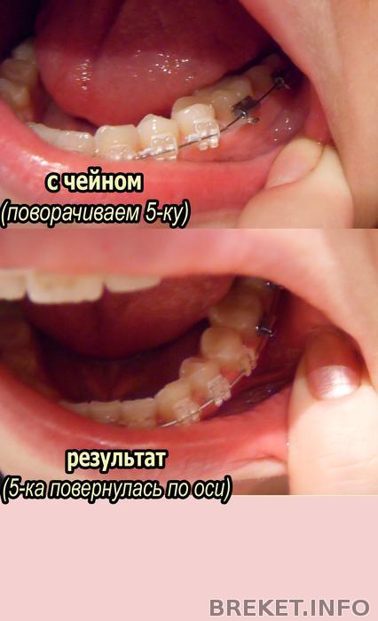 posle_cheyna_5_mes_nch