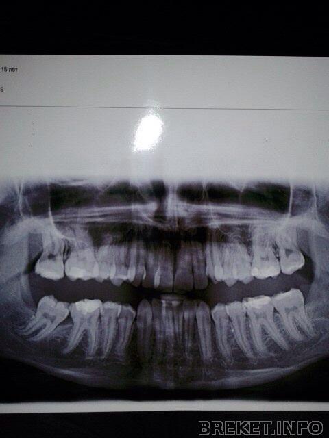 Ортопантомограмма после удаления восьмерок