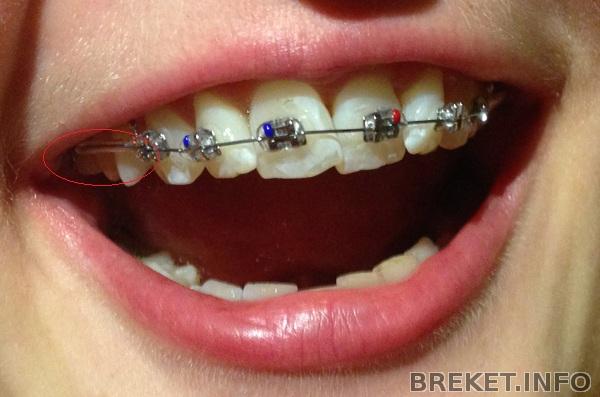 braces.jpg