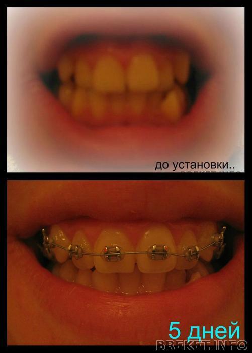Долго ли будут болеть зубы с брекетами Долго ли будут болеть зубы с брекетами