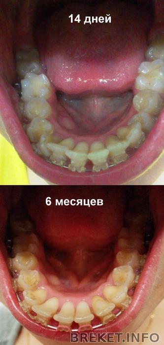 НЧ 14 дней- 6 месяцев