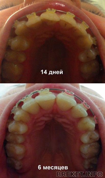 ВЧ 14 дней- 6 мес
