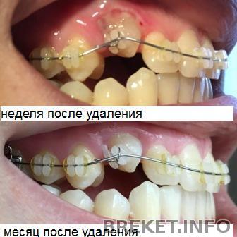 прогресс правого клыка за месяц.jpg